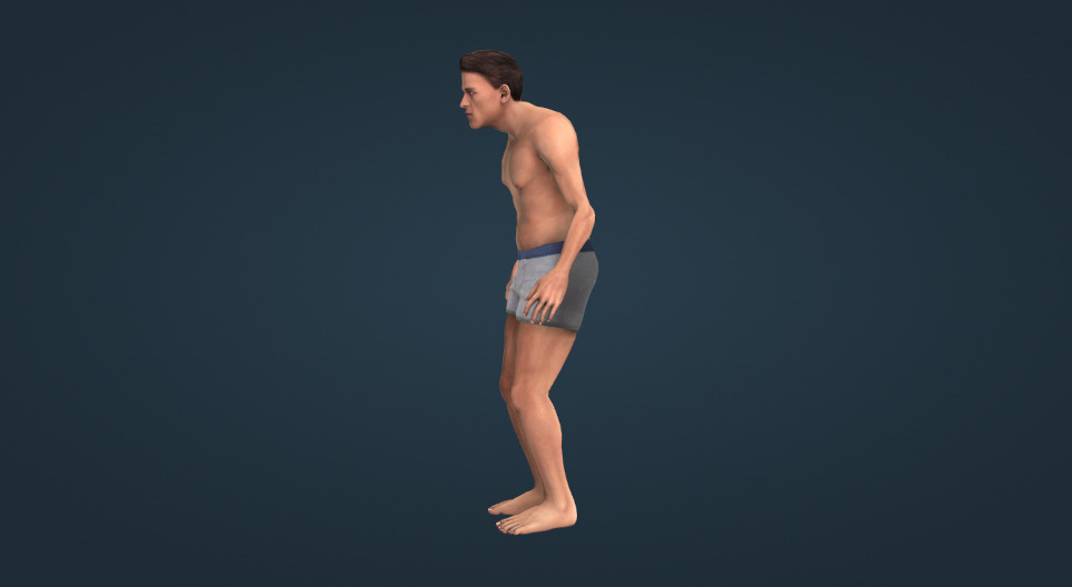 Ankylosing spondylitis (ankylosis of the spine and sacroiliac (SI) joints)