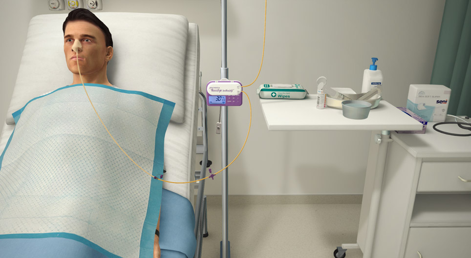 Nasogastric tube feeding