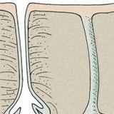 Арьсны булчирхай: өөхний булчирхай