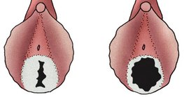 Залуу охины онгон хальс (зүүн талд) болон идэвхтэй бэлгийн амьдралтай эмэгтэйн онгон хальс (баруун)