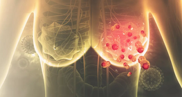 Role of physiotherapy in supporting recovery from breast cancer treatment